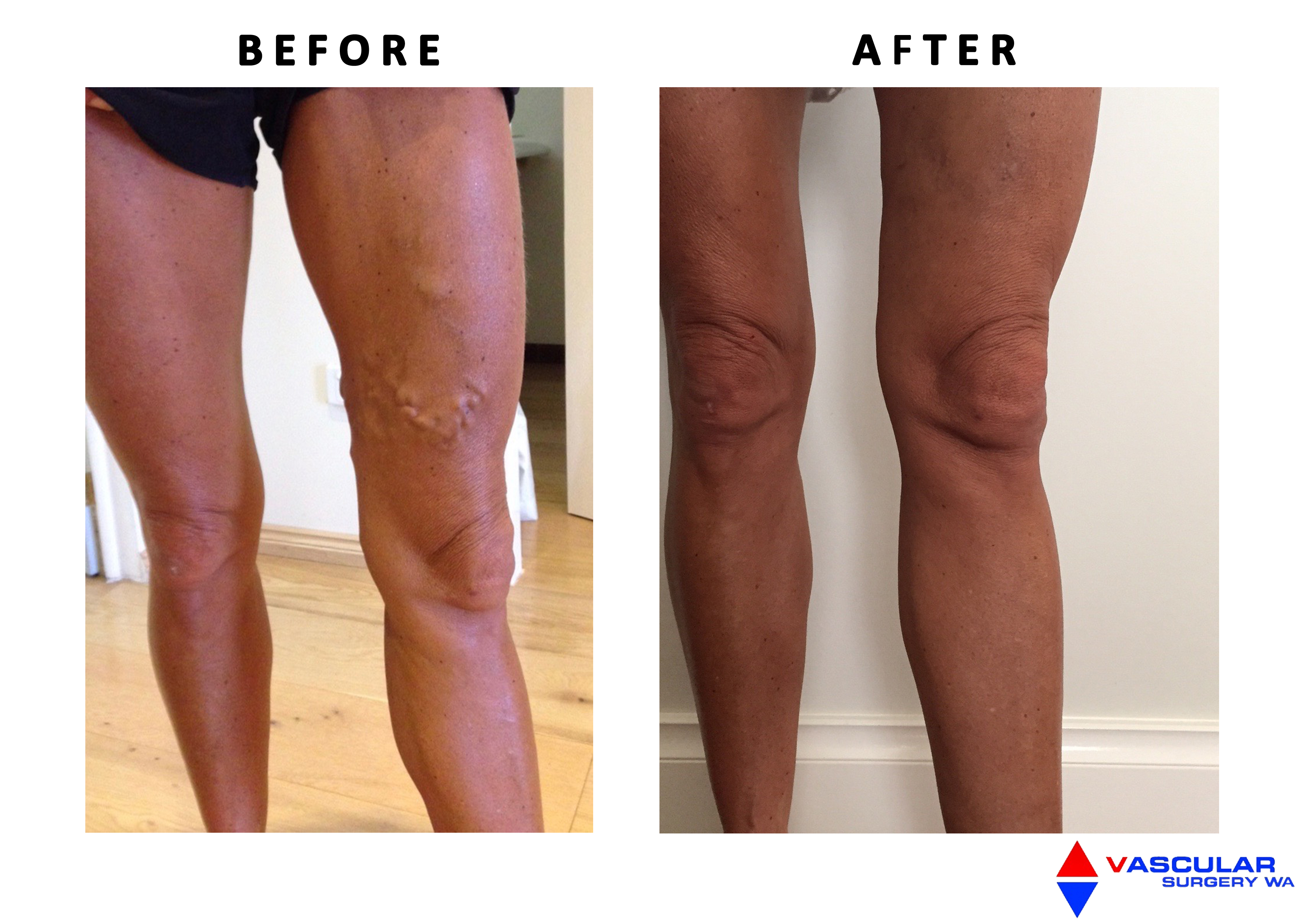 Surgery Vs Laser Treatment For Varicose Veins